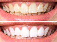 İşte mucizevi diş beyazlatma formülleri